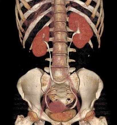 Urografía intravenosa y URO TAC