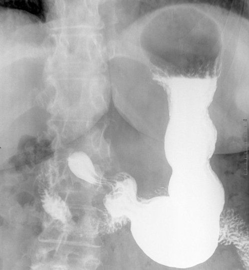 Estudios EGD y tránsito intestinal Estudios EGD y tránsito intestinal