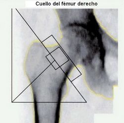 Valoración del riesgo de fractura de fémur Valoración del riesgo de fractura de fémur